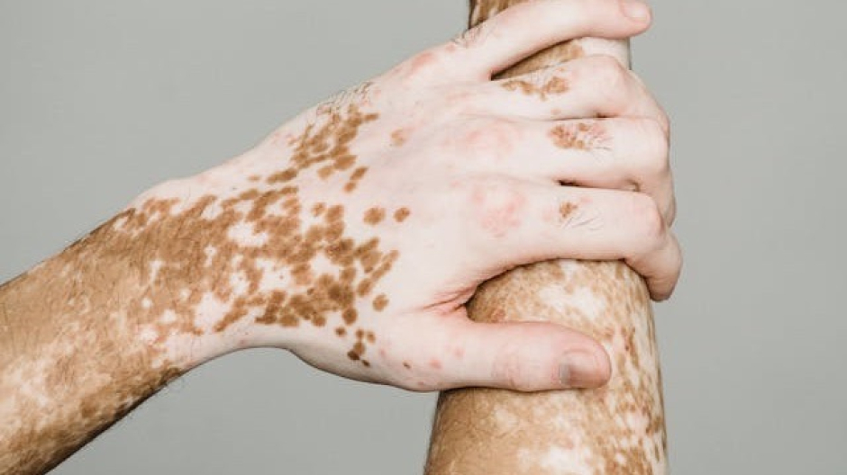 Anche la Dermatologia dell'Aou partecipa alla Vitiligine Week