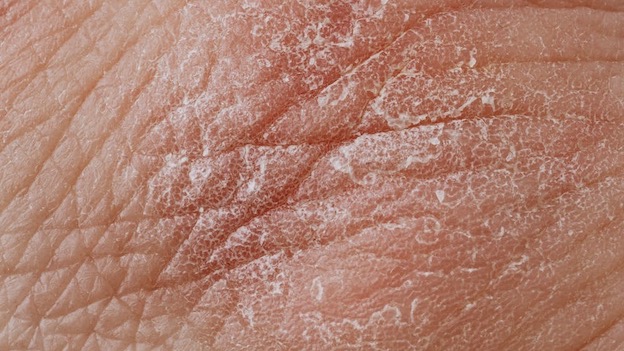 Campagna sulla dermatite atopica, visite gratuite all'Aou l'11 marzo