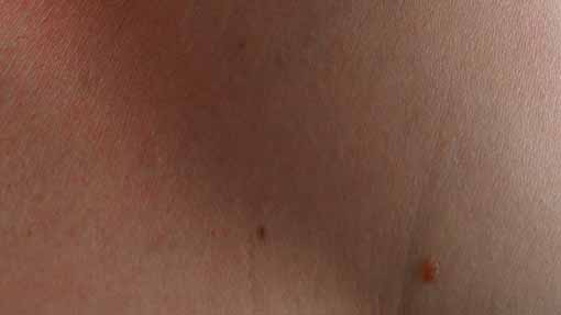 Trecate, campagna di prevenzione del melanoma cutaneo