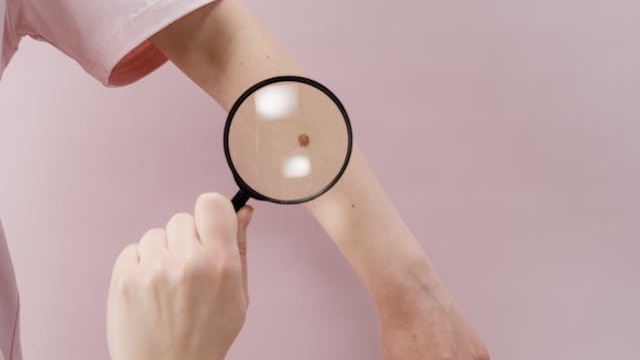Cerano, campagna di prevenzione del melanoma cutaneo