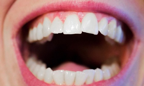 Oral Cancer Day: individuati quattro tumori del cavo orale